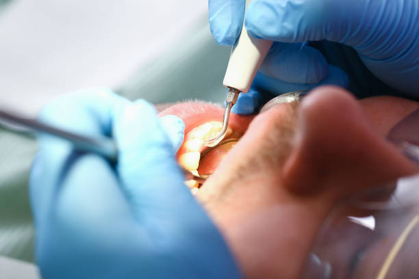 Best Emergency Root Canal Treatment in District Heights, MD